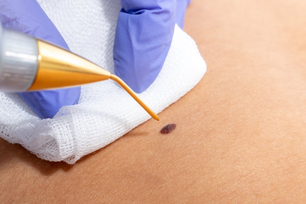 plasma-mole-removal-treatment-1.jpeg