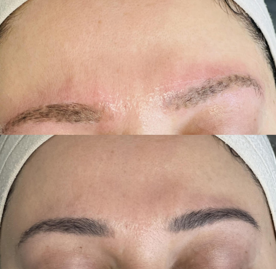 Saline Eyebrow Tattoo Removal Before and After: When Is It Better