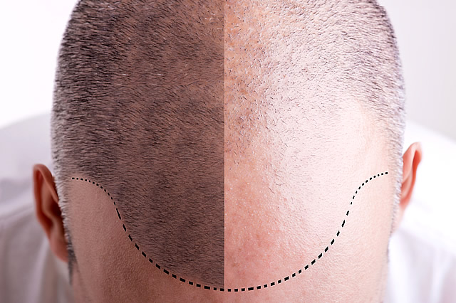 Scalp Hair Loss Micropigmentation Tattoo Leeds for Men