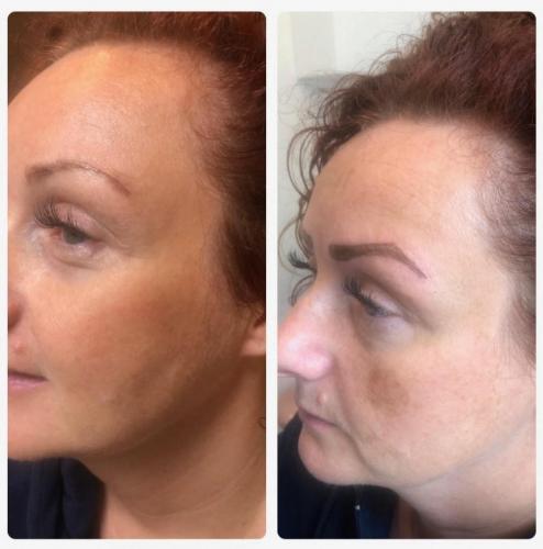 eyebrows-enhancement-leeds